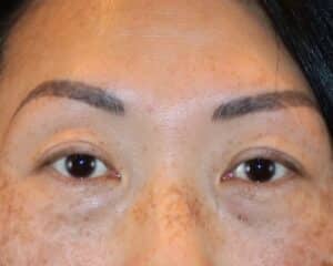 Before Image: Patient Case #3332