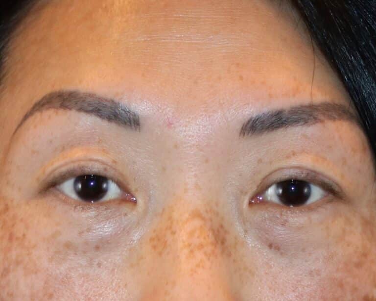 Before Image: Patient Case #3332 - front