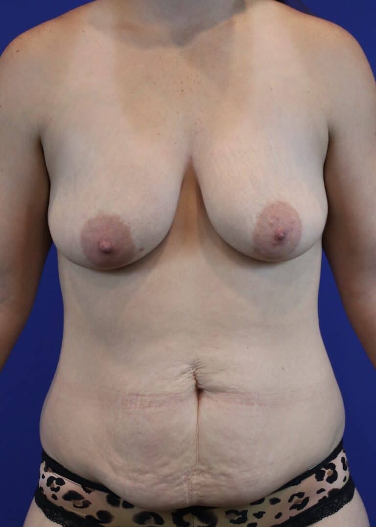 Before Image: Patient Case #3184 - front