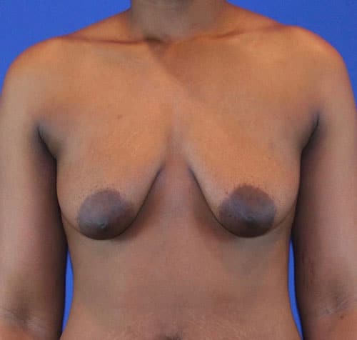 Before Image: Patient Case #3017 - front