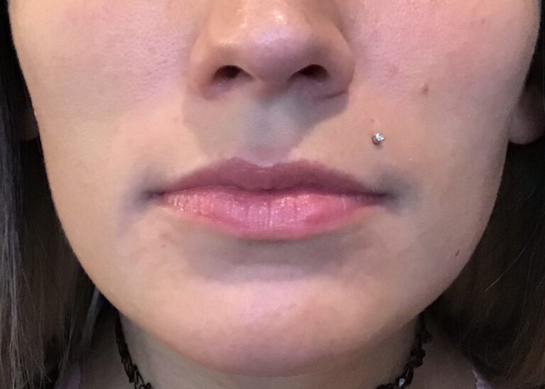 Before Image: Patient Case 1005 - front
