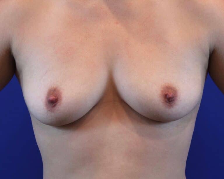 Before Image: Patient Case #2932 - front