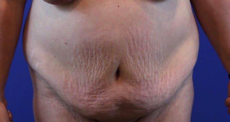Before Image: Patient Case #3869 - front