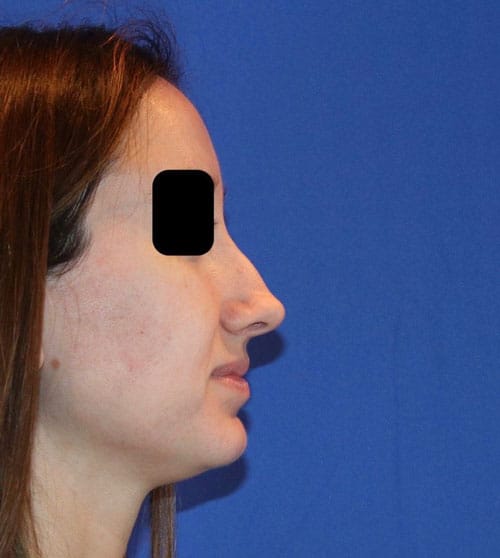 Before Image: Case Patient 2 - right-side