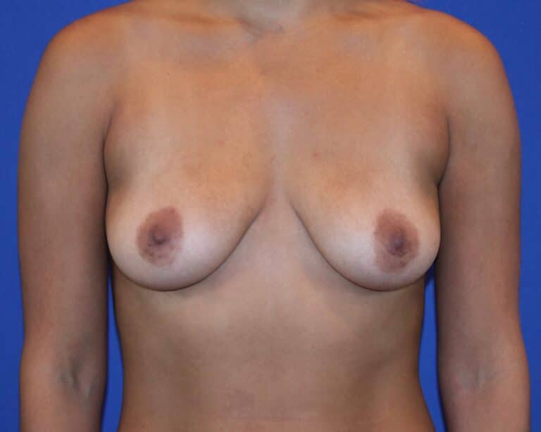 Before Image: Patient Case #2909 - front