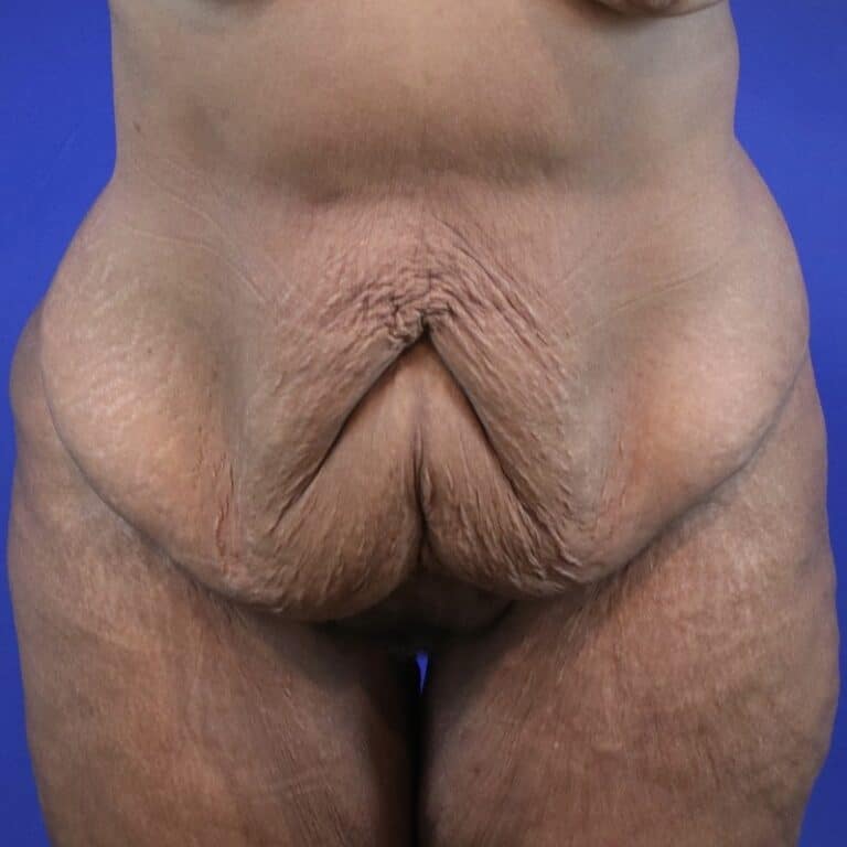 Before Image: Patient Case #3119 - front