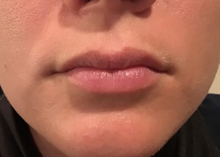 Before Image: Patient Case #1006 - front