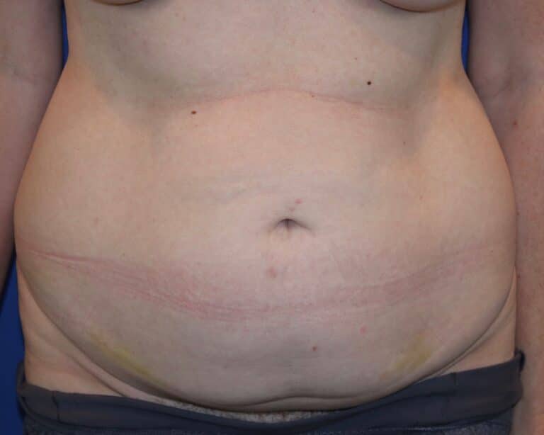 Before Image: Patient Case #3882 - front