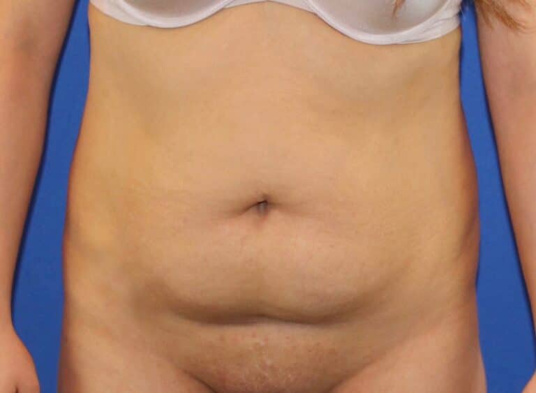 Before Image: Patient Case #3991 - front
