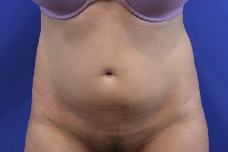 Before Image: Patient Case #3215 - front