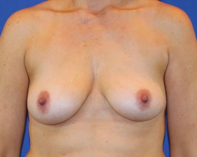 Before Image: Patient Case #2908 - front