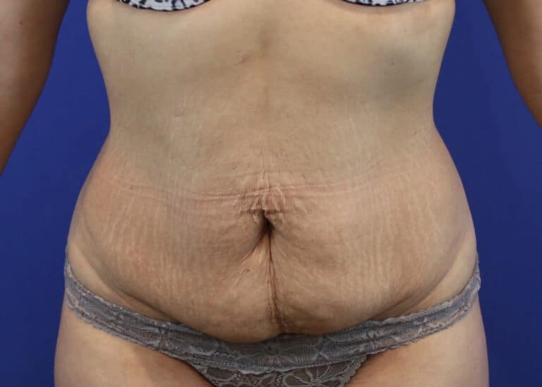 Before Image: Patient Case #3883 - front