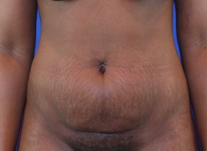 Before Image: Patient Case #3775 - front