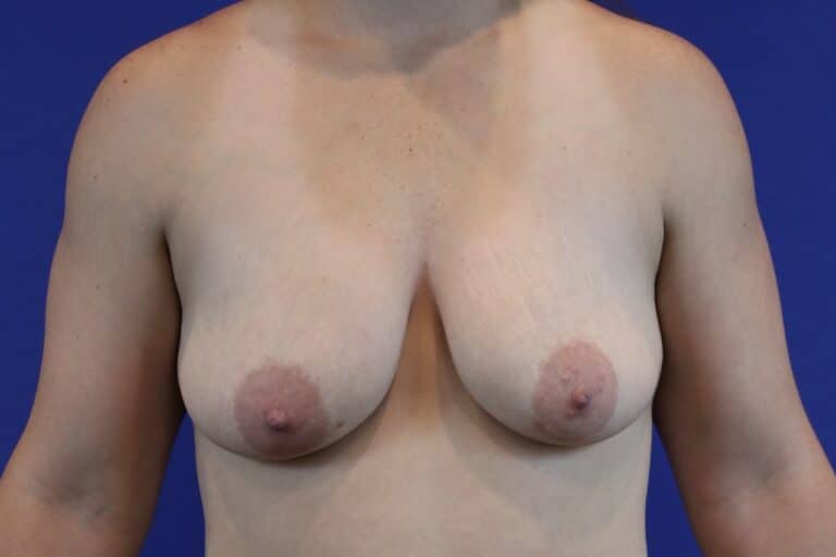 Before Image: Patient Case #3114 - front