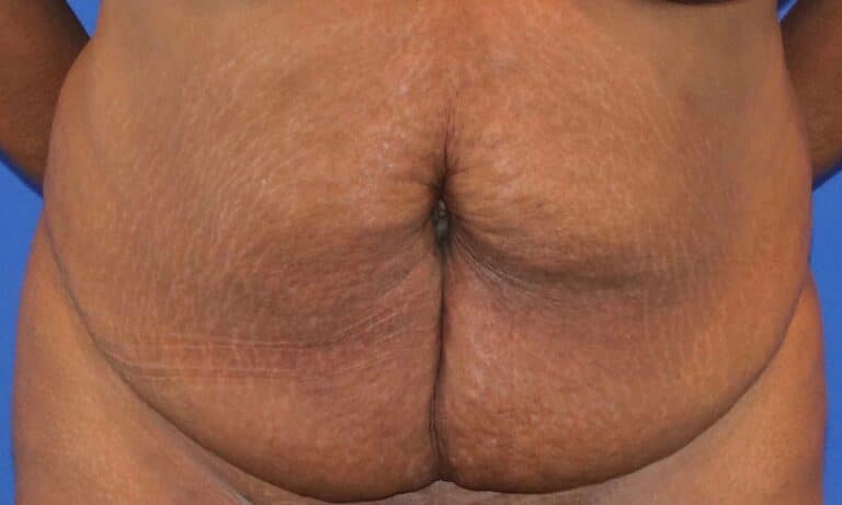 Before Image: Patient Case #3118 - front