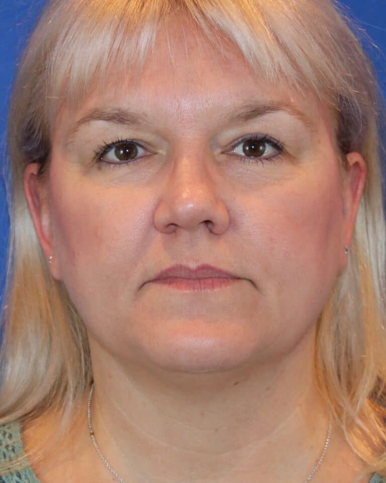 Before Image: Patient Case #3614 - front