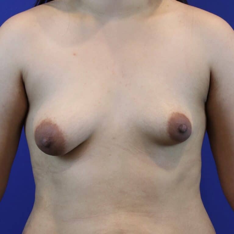 Before Image: Patient Case #3654 - front