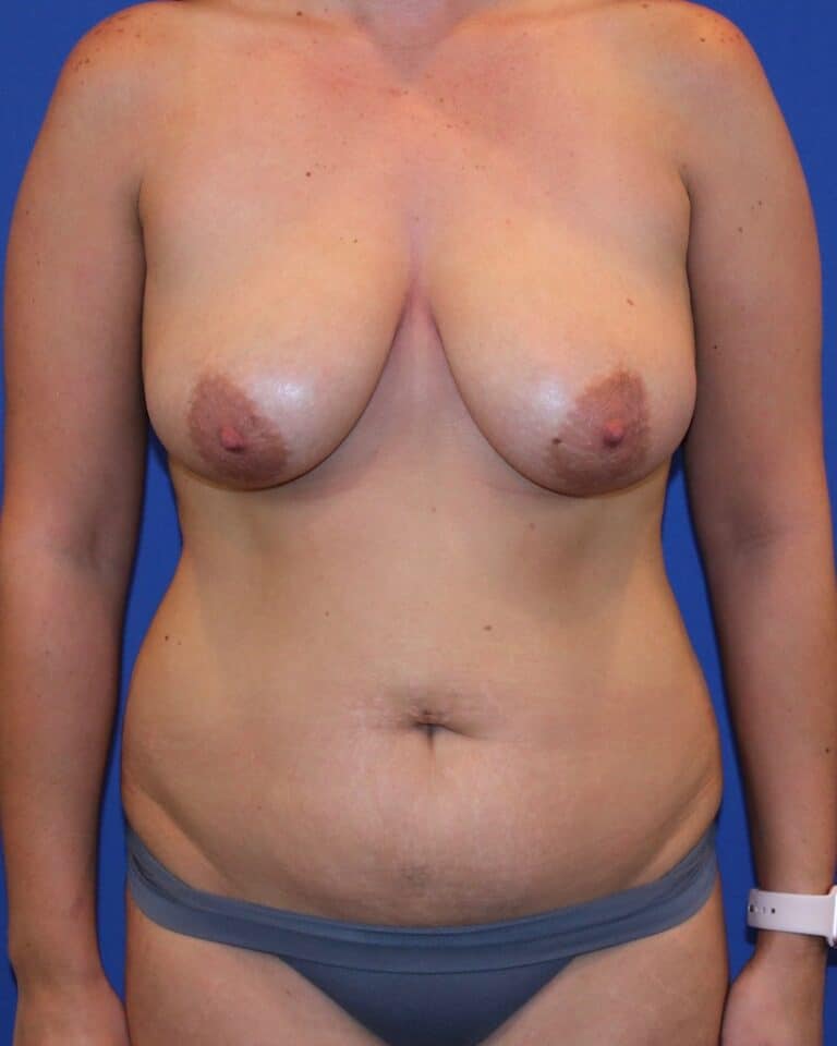Before Image: Patient Case #2988 - front