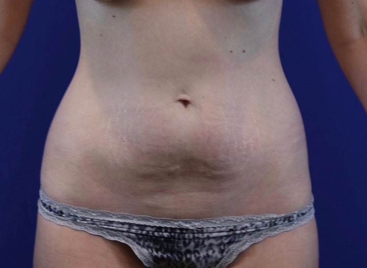 Before Image: Patient Case #3988 - front