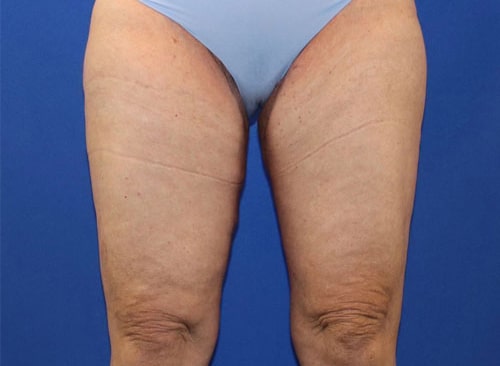 After Image: Patient 1 - front