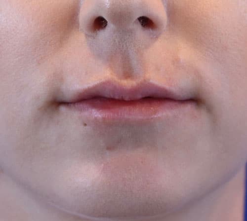 After Image: Patient #1001 - front