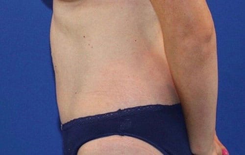 After Image: Patient Case #3989 - left-side