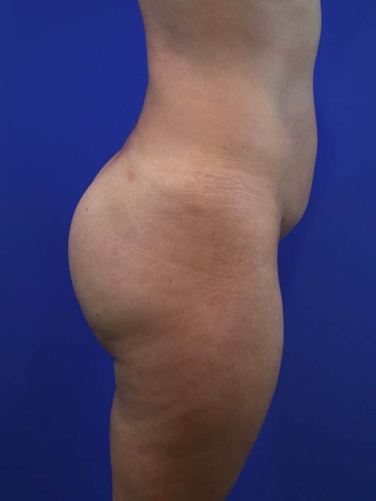 After Image: Patient Case #4012 - right-side