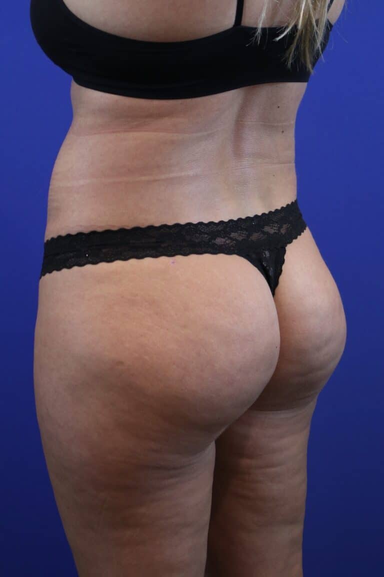 After Image: Patient Case #4010 - left-back-oblique