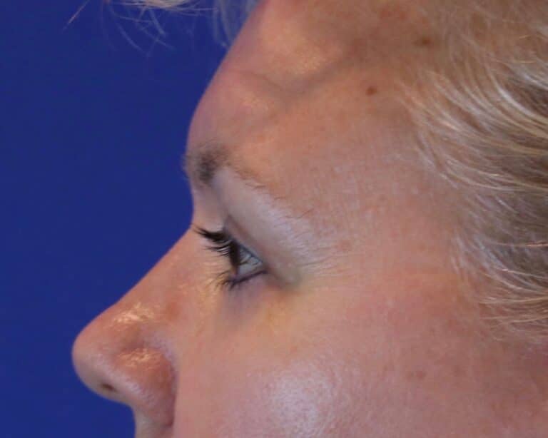 After Image: Patient Case #3068 - left-side