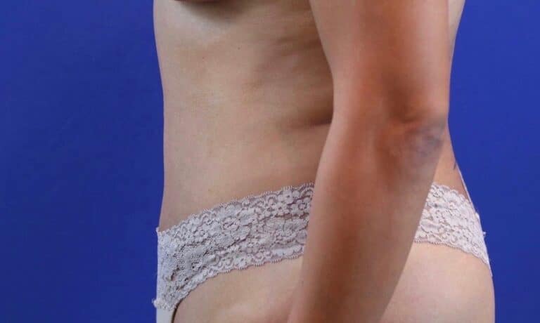 After Image: Patient Case #3776 - left-side