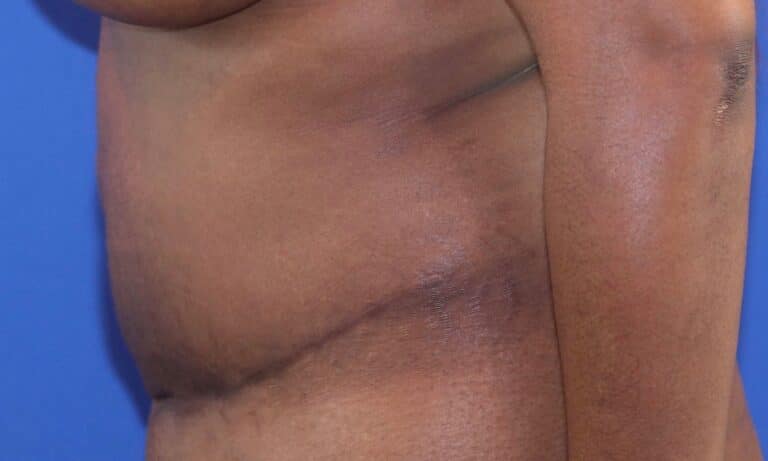After Image: Patient Case #3118 - left-side
