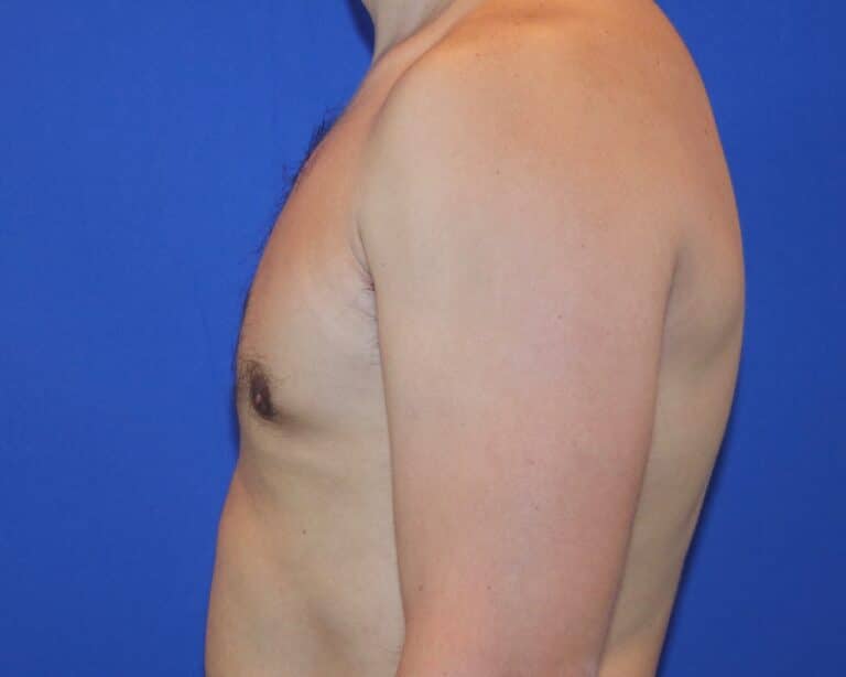 After Image: Patient Case #1053 - left-side