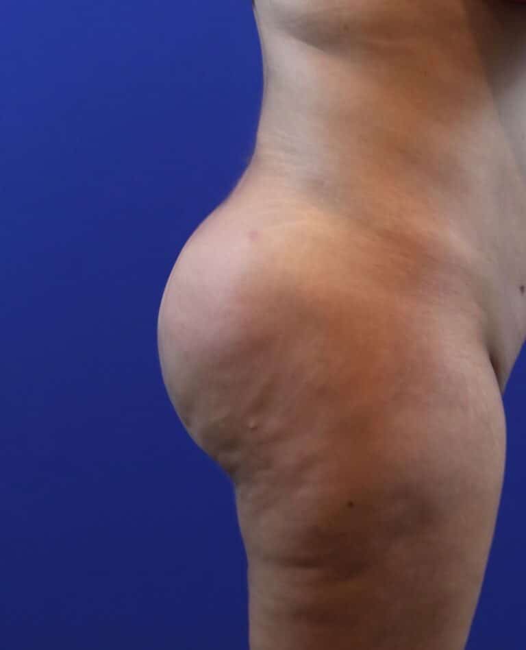 After Image: Patient Case #4002 - right-side
