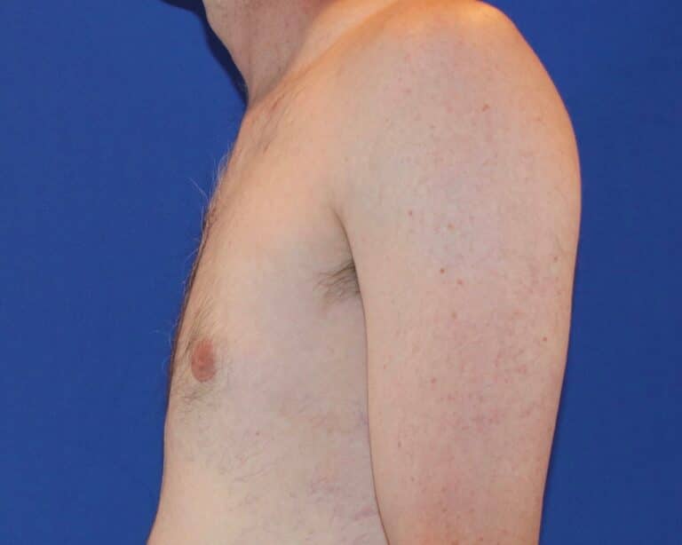 After Image: Patient Case #1049 - left-side
