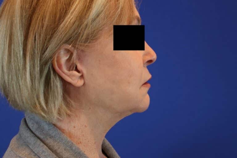 After Image: Patient Case #3621 - right-side