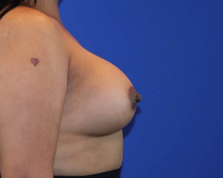After Image: Patient Case #5749 - right-side