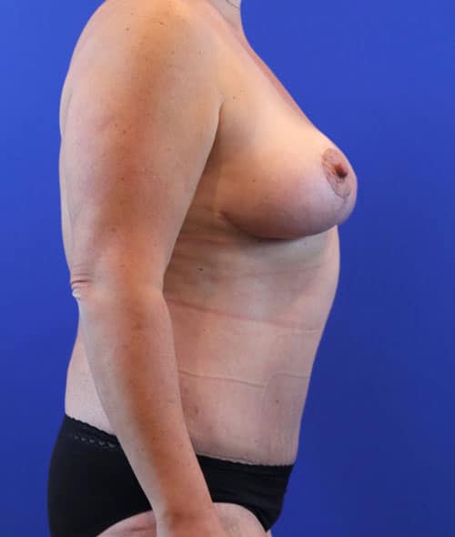 After Image: Patient Case #3006 - right-side
