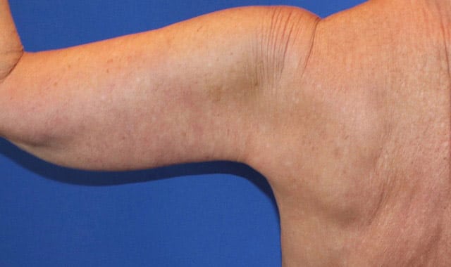After Image: Patient Case #1107 - back