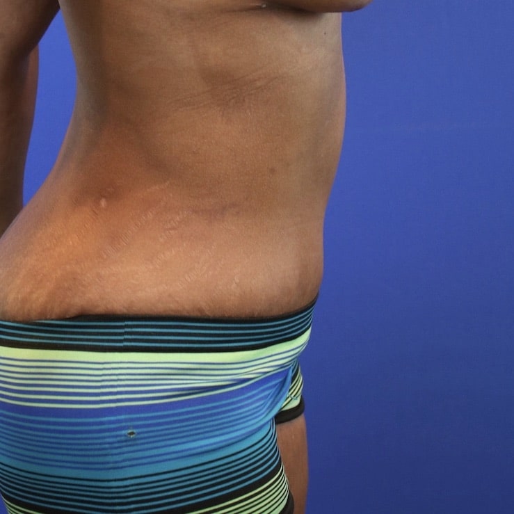 After Image: Patient Case #3119 - right-side