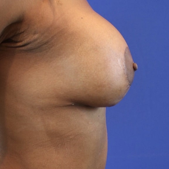 After Image: Patient Case #3220 - right-side