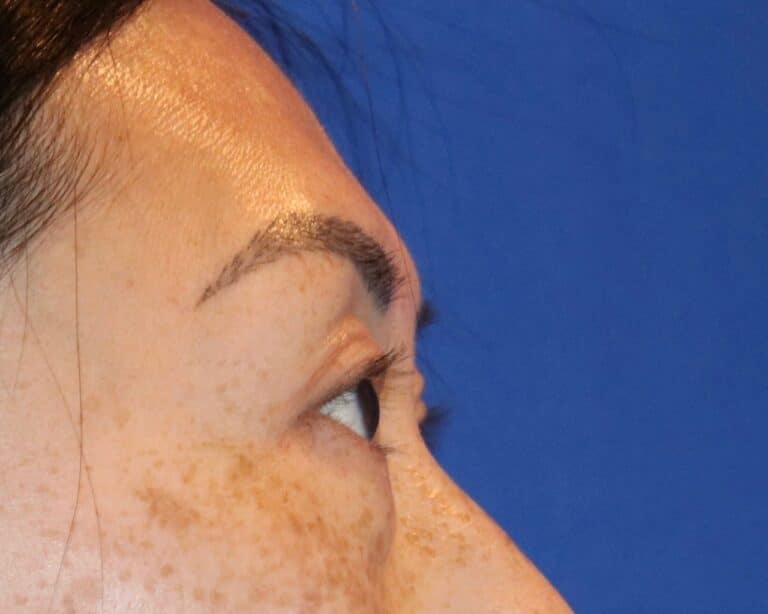 After Image: Patient Case #3332 - right-side