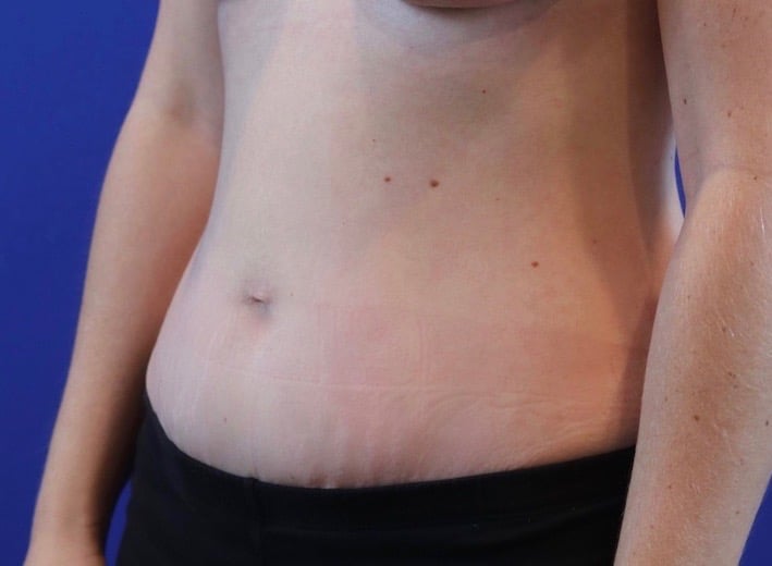 After Image: Patient Case #3988 - left-front-oblique
