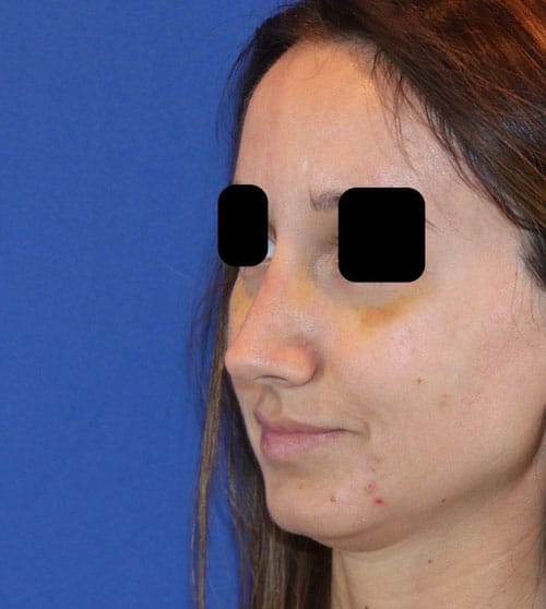 After Image: Case Patient 2 - left-front-oblique