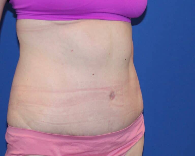 After Image: Patient Case #3882 - right-front-oblique