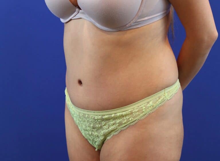 After Image: Patient Case #3991 - left-front-oblique