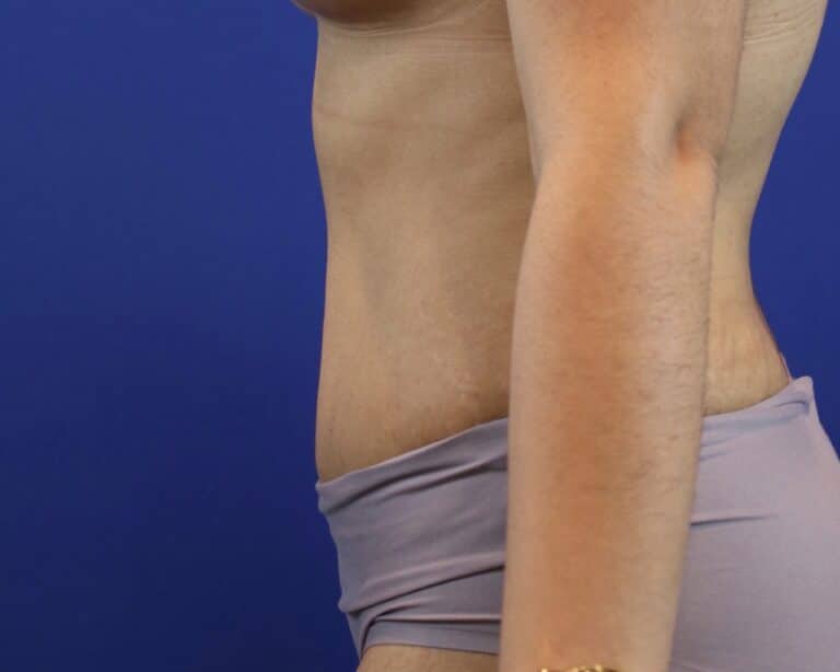 After Image: Patient Case #3109 - left-side
