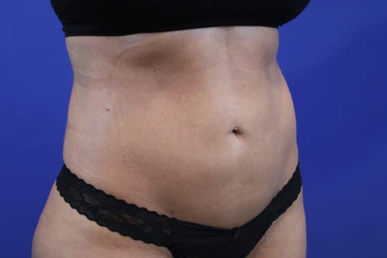 After Image: Patient Case #3215 - right-front-oblique