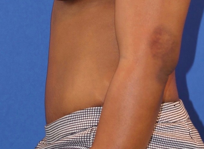 After Image: Patient Case #3775 - left-side