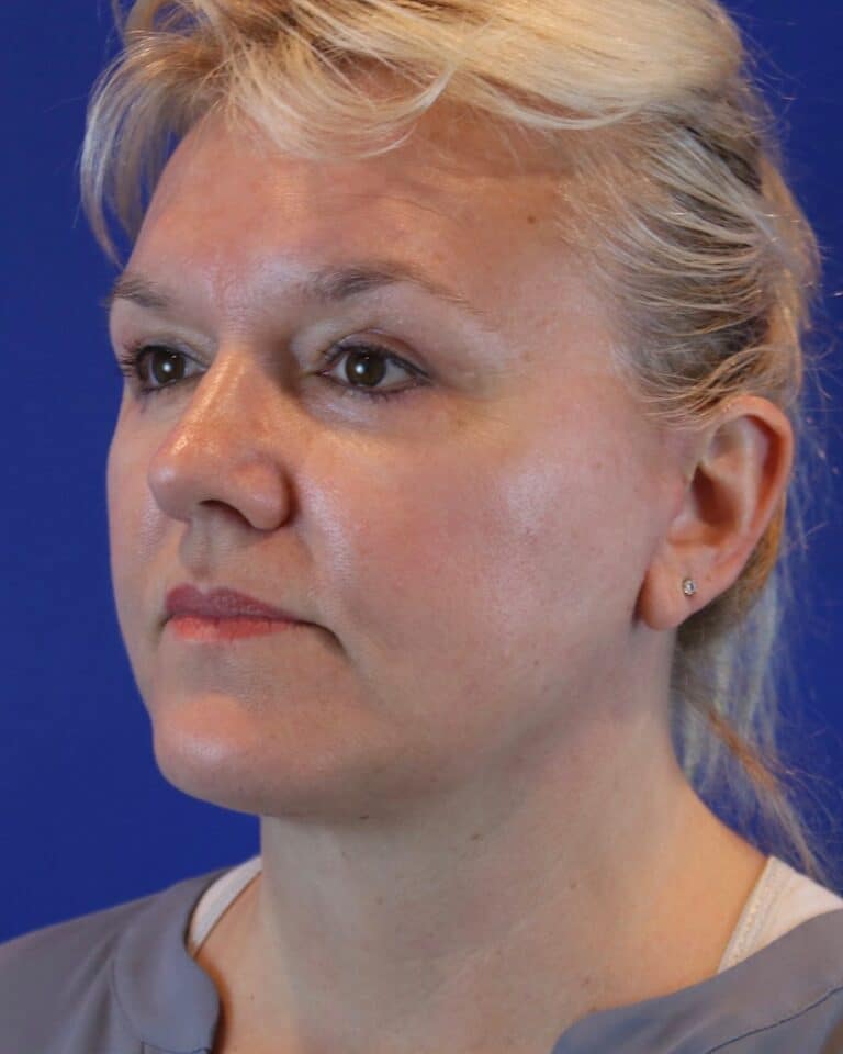 After Image: Patient Case #3614 - left-front-oblique