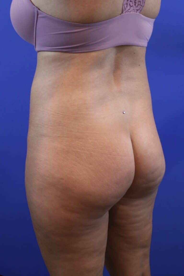 Before Image: Patient Case #4010 - left-back-oblique